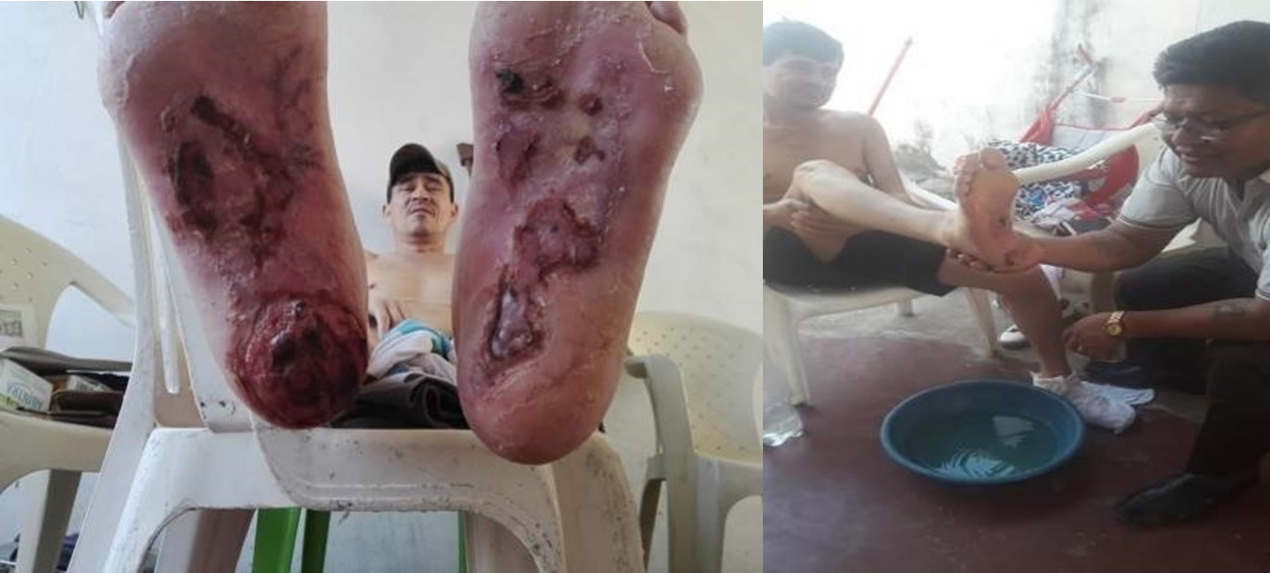 Before & After: Gangrene